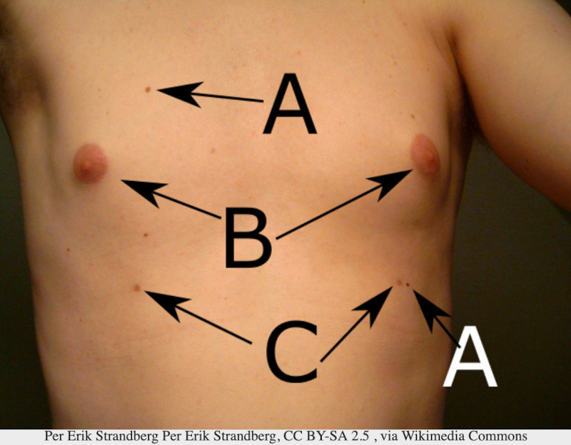 polythelia, supernumerary nipples